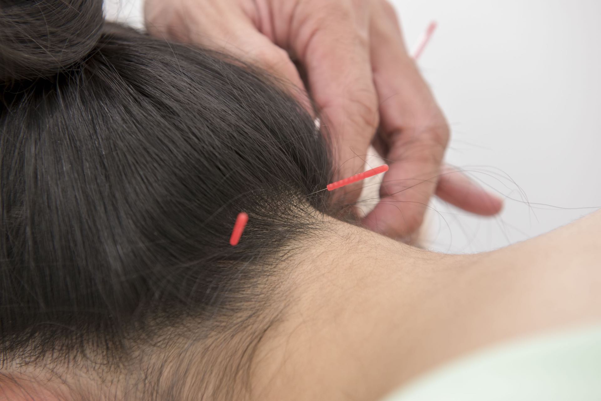 A woman get acupuncture treatment on her neck