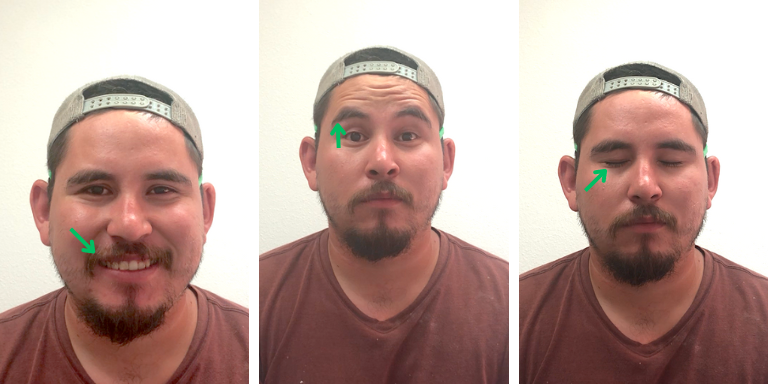 Bell's Palsy Acupuncture Before & After