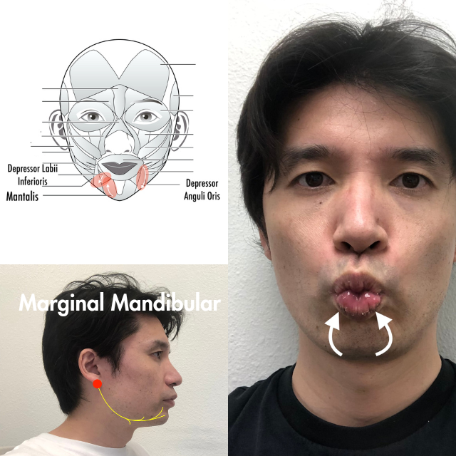 Mantalis: Bell's Palsy scale