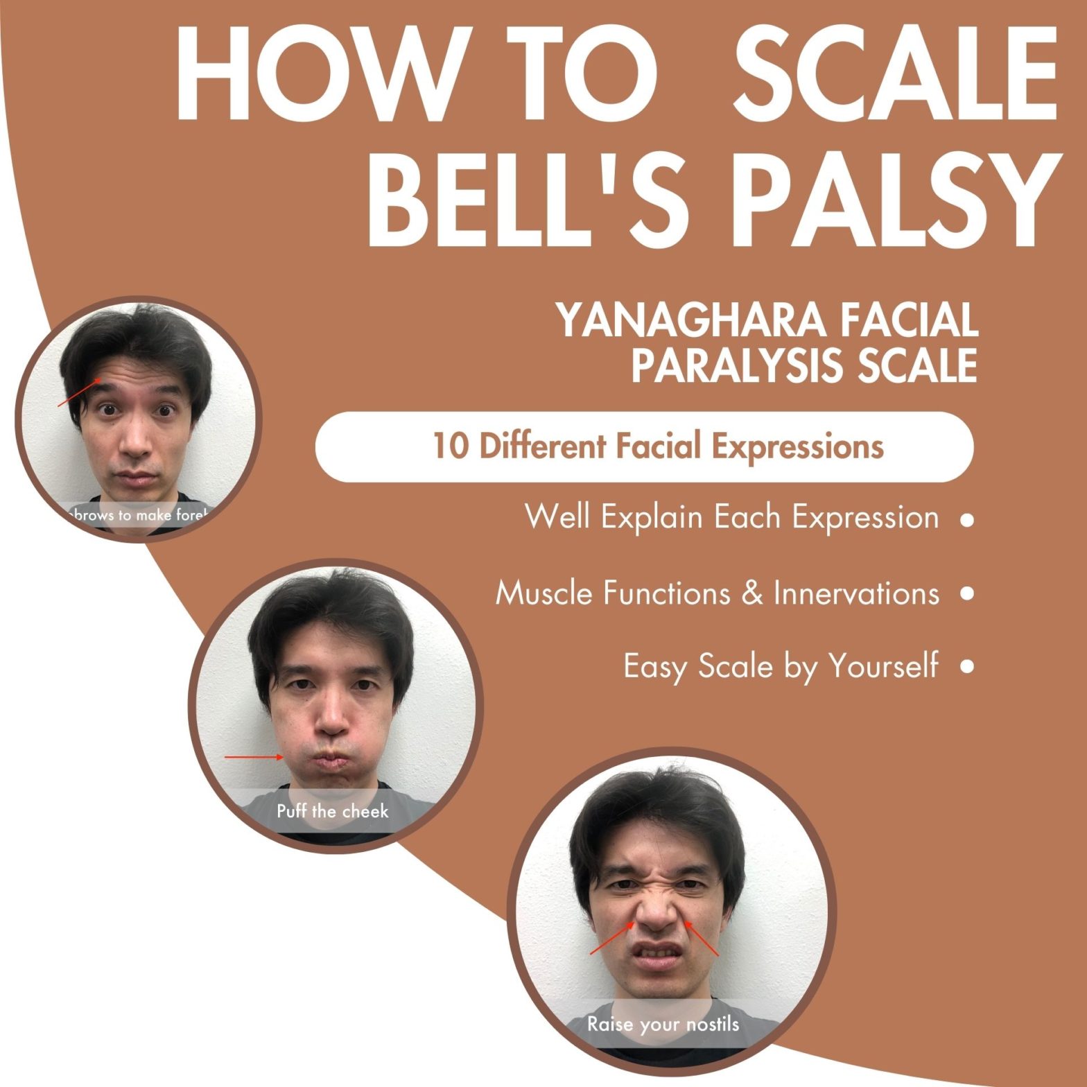 How to scale Bell's Palsy by Yourself