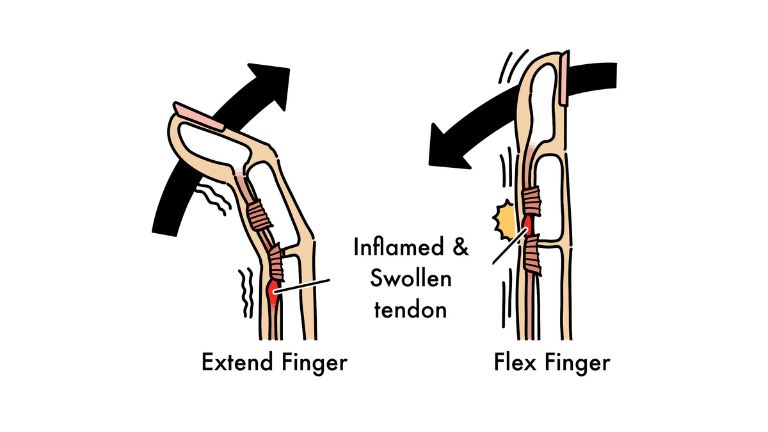The mechanism of trigger finger