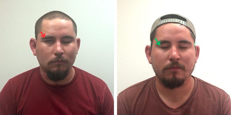 Bell's Palsy eye movement before & after