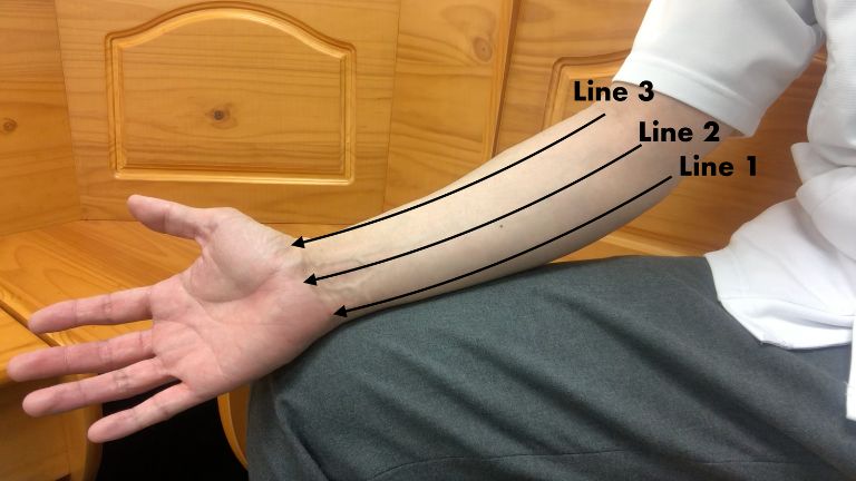 3 Lines on Forearm Massage for Trigger Finger
