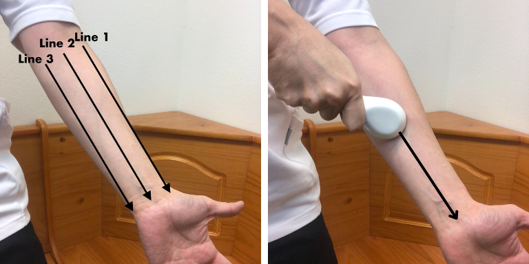 spoon technique on Forearm for trigger finger