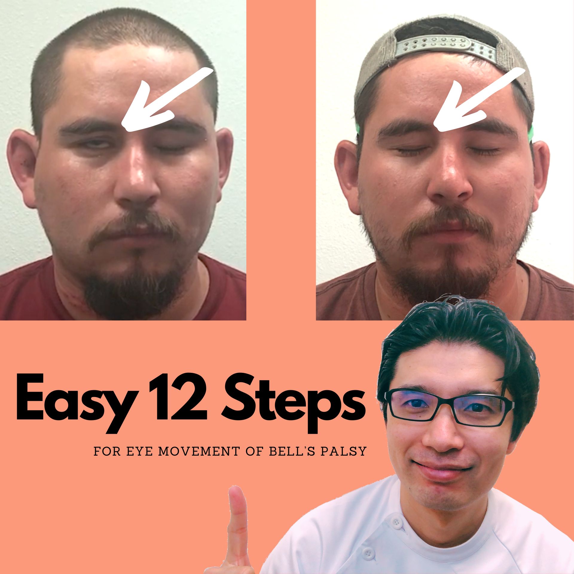 Easy 12 Steps for Bell's Palsy