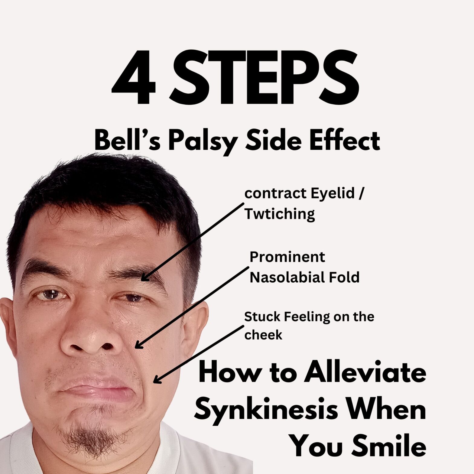 4 STEPS for Synkinesis