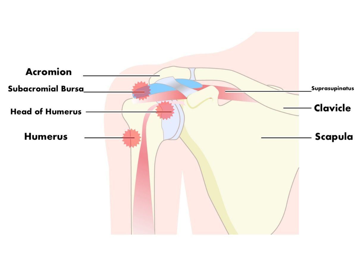 What is Frozen Shoulder?