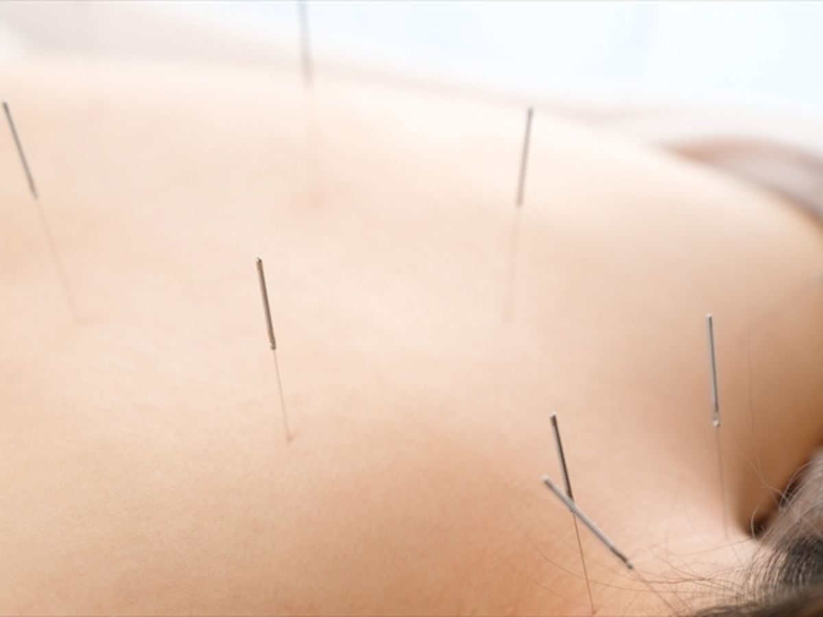 Acupuncture & Carpal Tunnel Syndrome