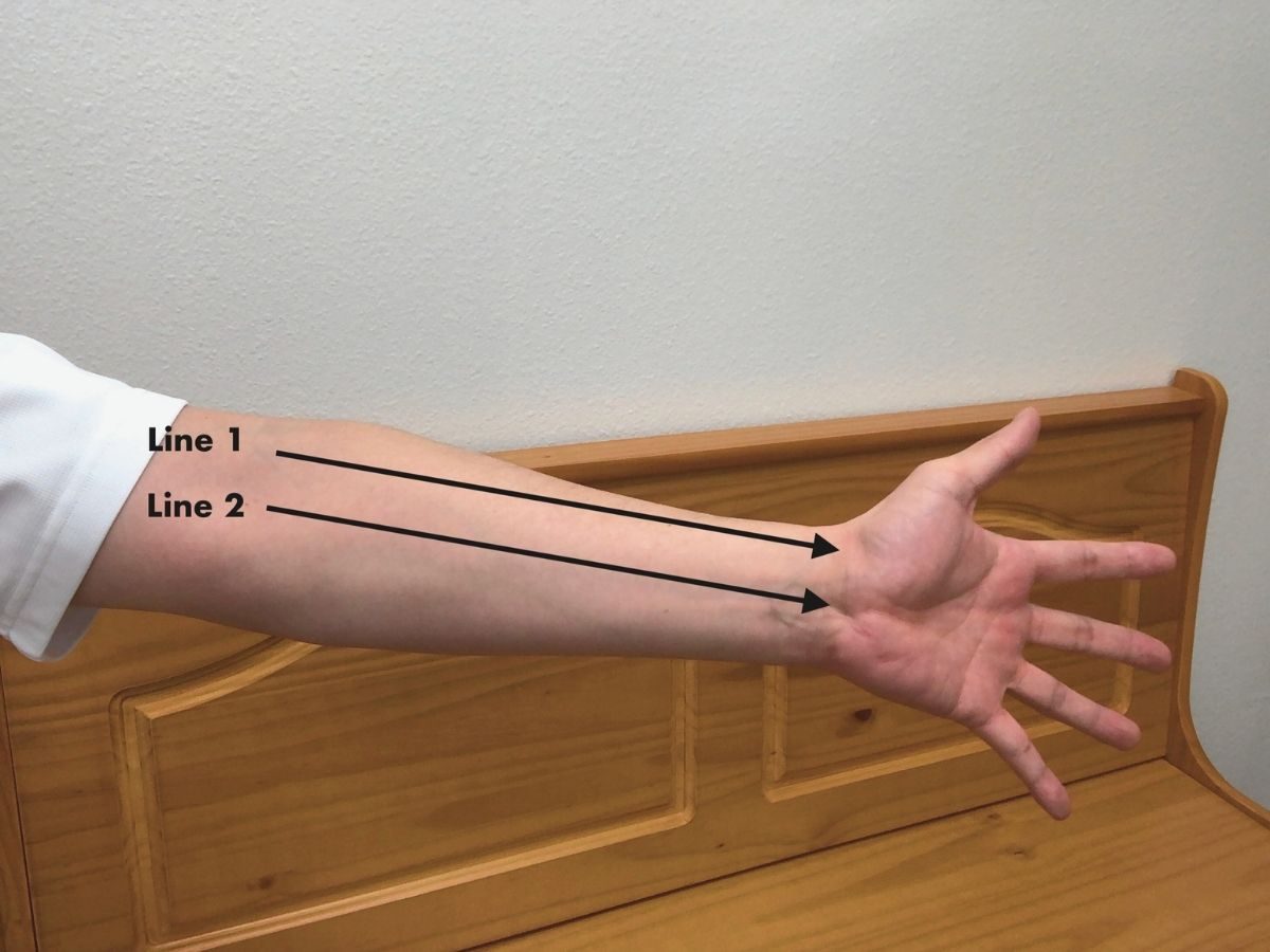 Forearm Massage for Carpal Tunnel Syndrome