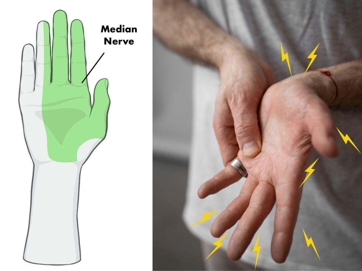 What is Carpal Tunnel Syndrome?