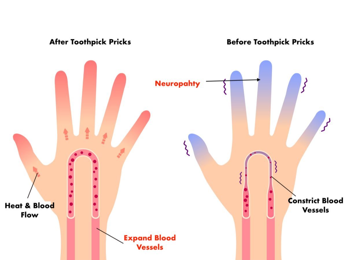 Benefits of toothpick pricks