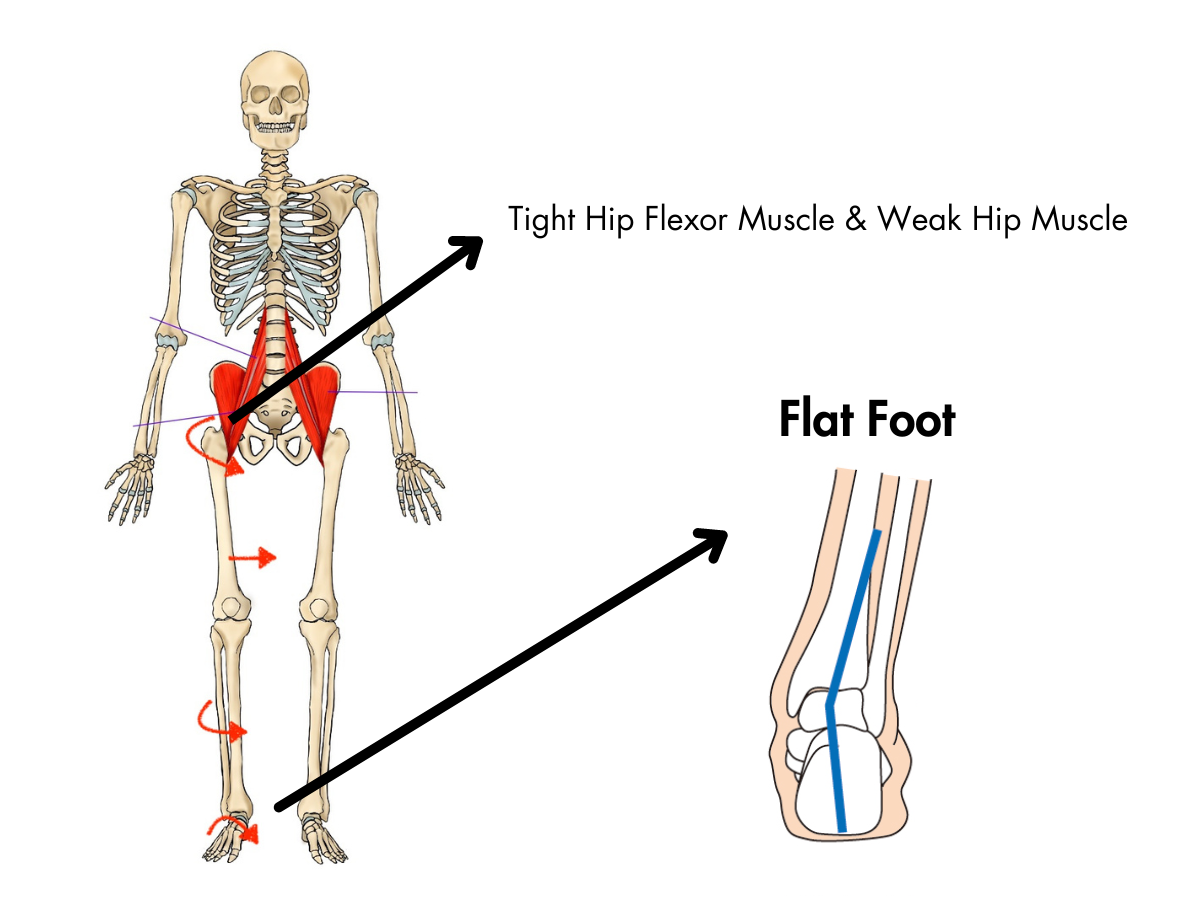 Tight Hip Muscle makes Flat Feet Causing Plantar Fasciitis