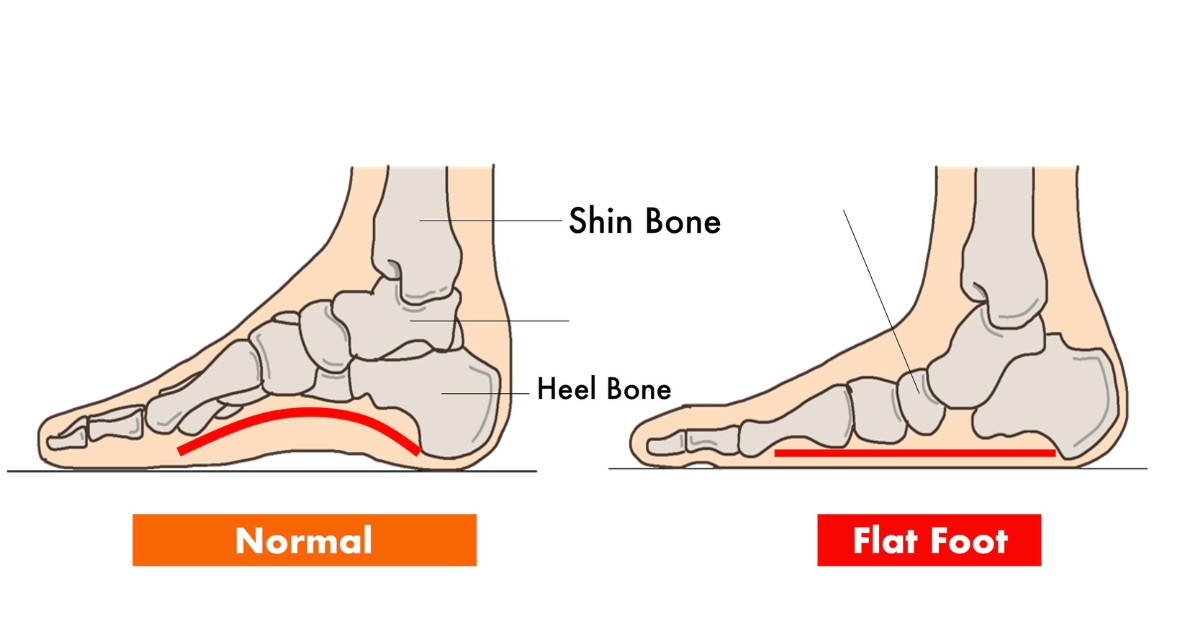 Flat Feet for Plantar Fasciitis