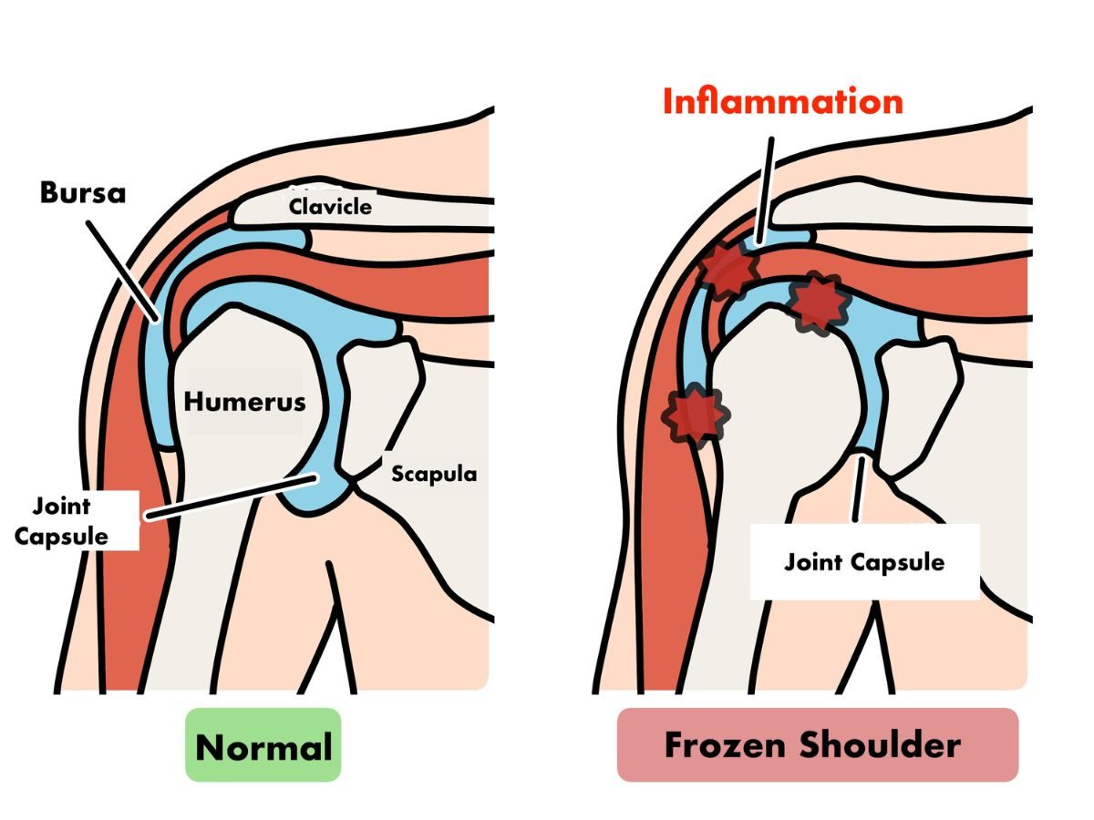 What is Frozen Shoulder?